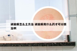 顽固癣怎么土方治 顽固癣用什么药才可以根治啊