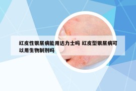 红皮性银屑病能用达力士吗 红皮型银屑病可以用生物制剂吗