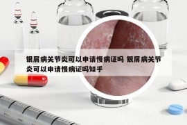 银屑病关节炎可以申请慢病证吗 银屑病关节炎可以申请慢病证吗知乎