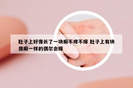 肚子上好像长了一块癣不疼不痒 肚子上有块像癣一样的偶尔会痒