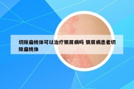 切除扁桃体可以治疗银屑病吗 银屑病患者切除扁桃体