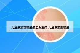 儿童点滴性银屑病怎么治疗 儿童点滴型银屑