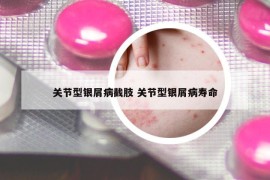 关节型银屑病截肢 关节型银屑病寿命