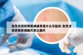 急性点滴状银屑病通常是什么引起的 急性点滴状银屑病图片恶化图片