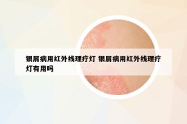 银屑病用红外线理疗灯 银屑病用红外线理疗灯有用吗