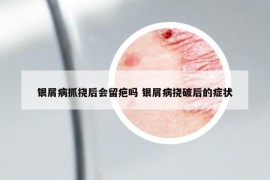 银屑病抓挠后会留疤吗 银屑病挠破后的症状