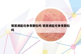 银屑病能吃参麦颗粒吗 银屑病能吃参麦颗粒吗