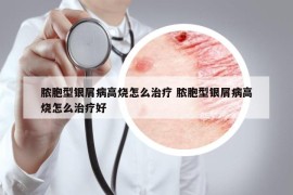 脓胞型银屑病高烧怎么治疗 脓胞型银屑病高烧怎么治疗好