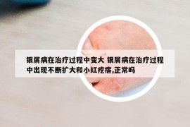 银屑病在治疗过程中变大 银屑病在治疗过程中出现不断扩大和小红疙瘩,正常吗