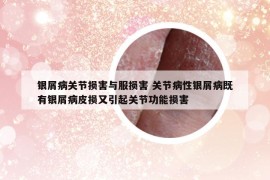 银屑病关节损害与服损害 关节病性银屑病既有银屑病皮损又引起关节功能损害