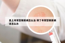 患上寻常型银屑病怎么治 得了寻常型银屑病该怎么办