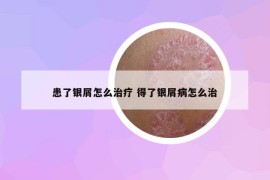 患了银屑怎么治疗 得了银屑病怎么治