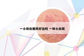 一小块白癜风好治吗 一块小白斑