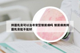 抑菌乳膏可以治寻常型银屑病吗 银屑病用抑菌乳膏能不能好