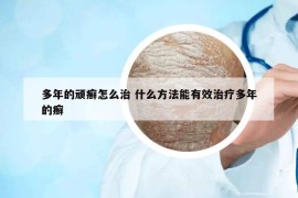 多年的顽癣怎么治 什么方法能有效治疗多年的癣