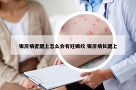 银屑病者腿上怎么会有妊娠纹 银屑病长腿上