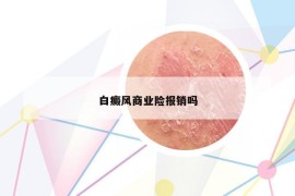 白癜风商业险报销吗