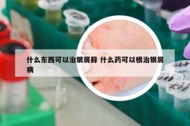 什么东西可以治银屑藓 什么药可以根治银屑病