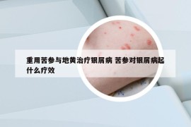 重用苦参与地黄治疗银屑病 苦参对银屑病起什么疗效