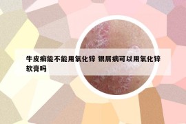 牛皮癣能不能用氧化锌 银屑病可以用氧化锌软膏吗