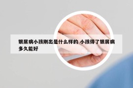 银屑病小孩刚出是什么样的 小孩得了银屑病多久能好