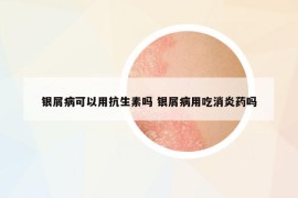 银屑病可以用抗生素吗 银屑病用吃消炎药吗