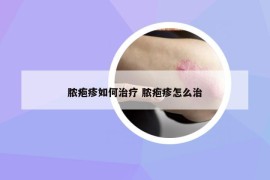 脓疱疹如何治疗 脓疱疹怎么治