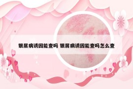 银屑病诱因能查吗 银屑病诱因能查吗怎么查