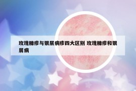 玫瑰糠疹与银屑病疹四大区别 玫瑰糠疹和银屑病