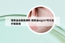 煤焦油治银屑病吗 煤焦油mg217可以治疗银屑病