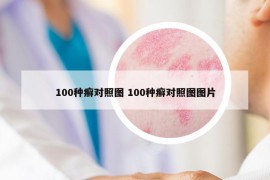 100种癣对照图 100种癣对照图图片