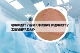 磕破膝盖好了后会长牛皮癣吗 膝盖破皮好了之后留疤印怎么办