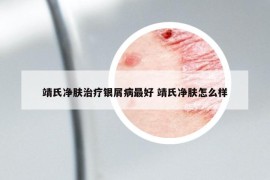 靖氏净肤治疗银屑病最好 靖氏净肤怎么样