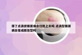 得了点滴状银屑病会往脸上长吗 点滴型银屑病会变成脓包型吗