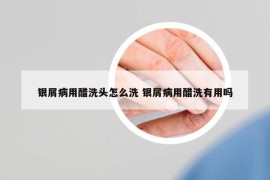 银屑病用醋洗头怎么洗 银屑病用醋洗有用吗