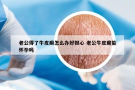 老公得了牛皮癣怎么办好担心 老公牛皮廨能怀孕吗