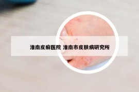 淮南皮癣医院 淮南市皮肤病研究所