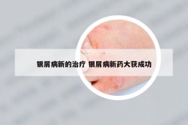 银屑病新的治疗 银屑病新药大获成功