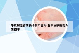 牛皮癣患者生孩子会严重吗 有牛皮病癣的人生孩子