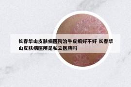 长春华山皮肤病医院治牛皮癣好不好 长春华山皮肤病医院是私立医院吗