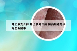 身上多处长藓 身上多处长藓 搽药后还是没好怎么回事