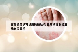 面部银屑病可以用胸腺肽吗 银屑病打胸腺五肽有效果吗