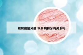 银屑病加牙痛 银屑病和牙有关系吗