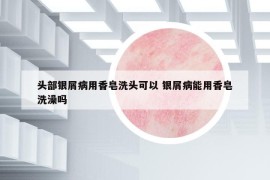 头部银屑病用香皂洗头可以 银屑病能用香皂洗澡吗