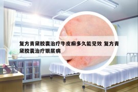 复方青黛胶囊治疗牛皮癣多久能见效 复方青黛胶囊治疗银屑病