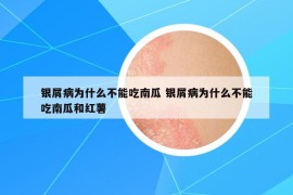 银屑病为什么不能吃南瓜 银屑病为什么不能吃南瓜和红薯