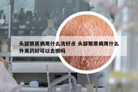 头部银屑病用什么洗好点 头部银屑病用什么外用药好可以去根吗