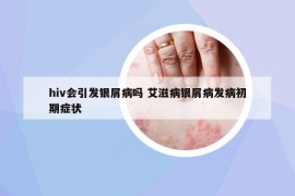 hiv会引发银屑病吗 艾滋病银屑病发病初期症状