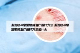 点滴状寻常型银屑治疗最好方法 点滴状寻常型银屑治疗最好方法是什么