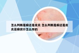 怎么判断是癣还是皮炎 怎么判断是癣还是皮炎苔癣状什怎么样的